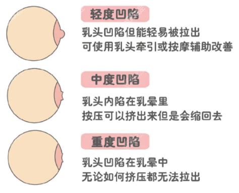 女人的奶頭|乳頭內凹、長毛正常嗎？ 8類「乳頭形狀」你的是哪種